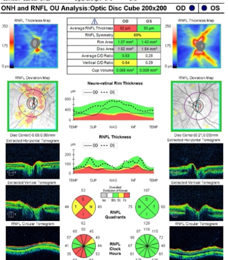 Macular thickness