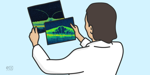 Guide to Common Macula Findings with OCT with Downloadable Cheat Sheet