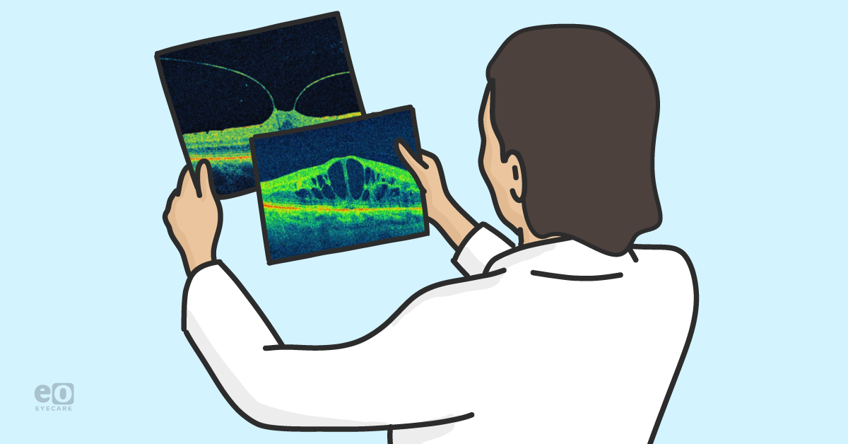 Guide to Common Macula Findings with OCT with Downloadable Cheat Sheet