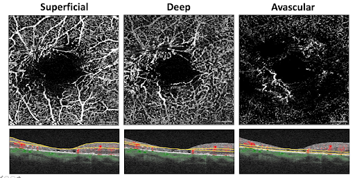 Macular Telangiectasia SD fundus