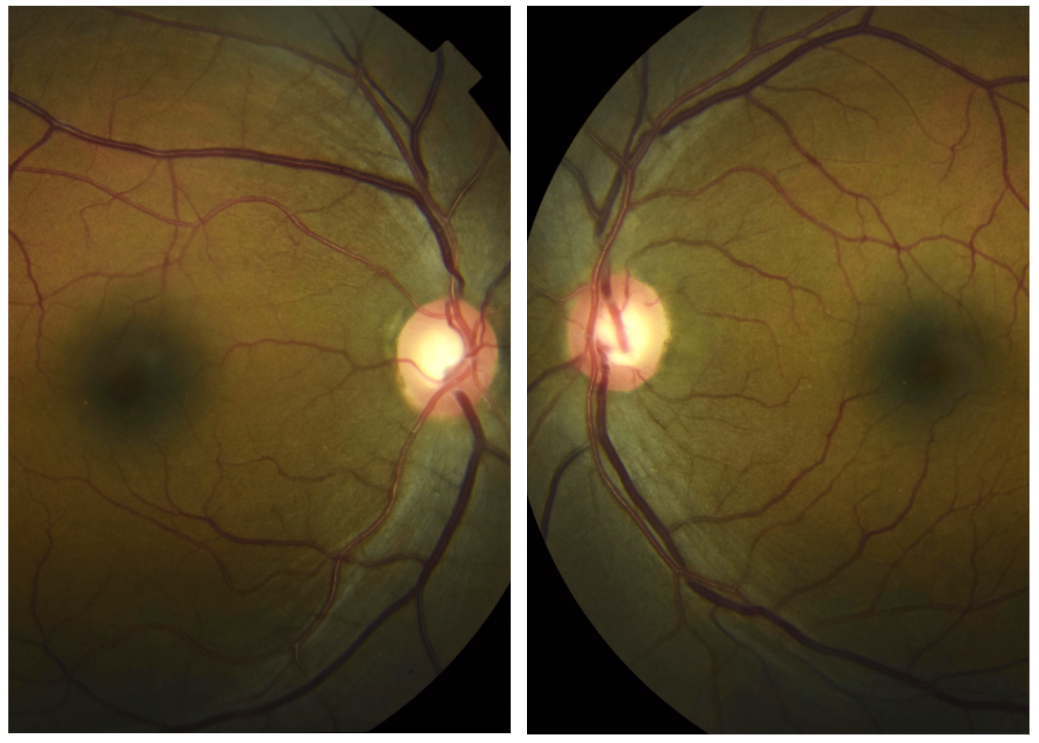 optic nerve disc.png