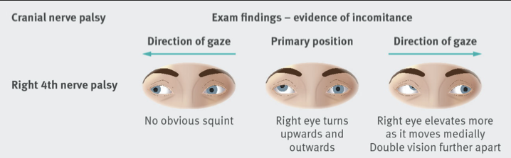 BMJ image of incomitance in right fourth nerve palsy