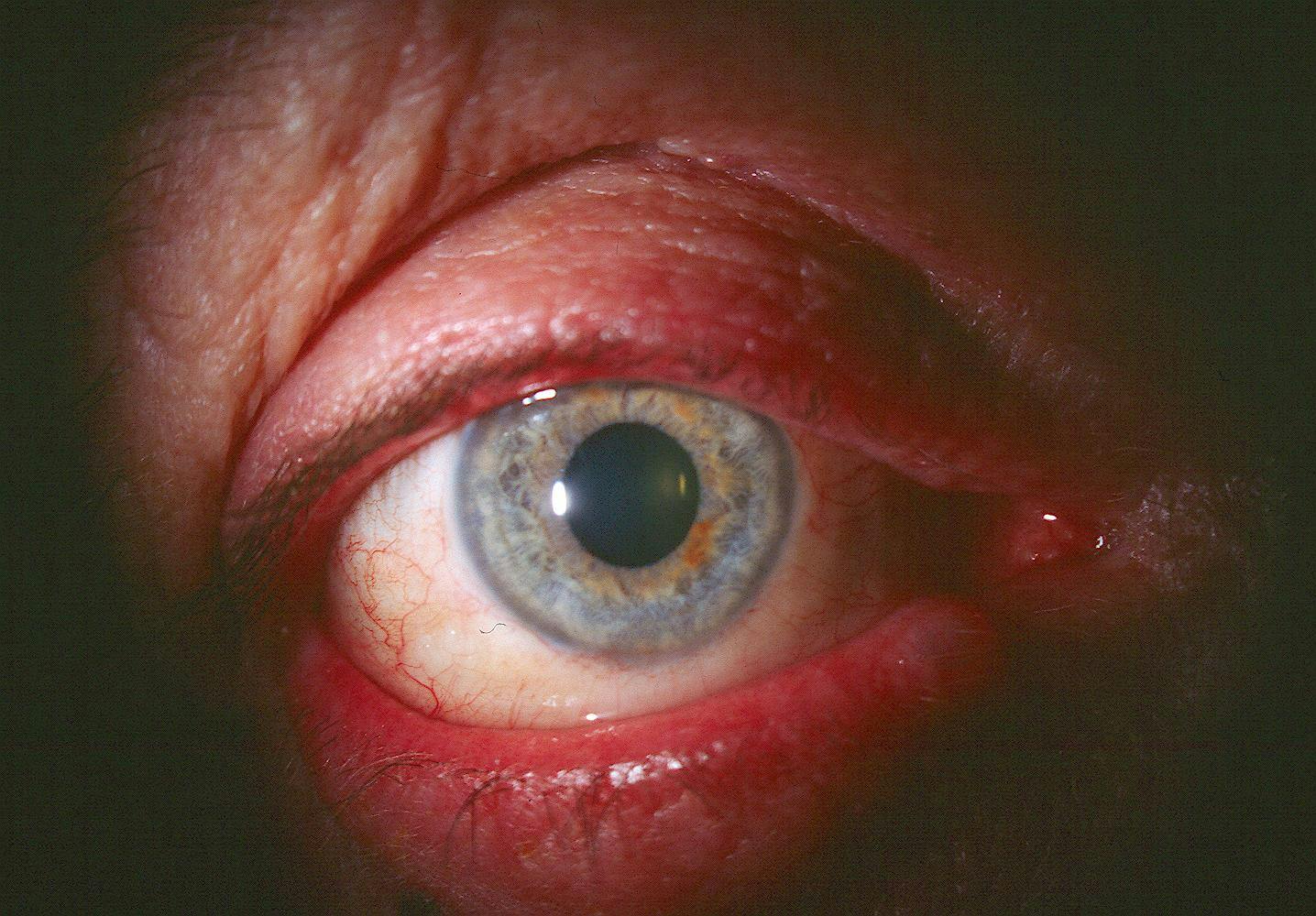 Bilateral blepharitis