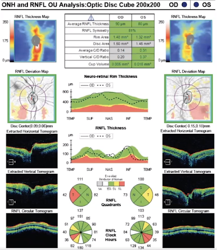 OCT RNFL