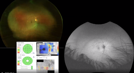 Tilt of the Optic Nerve