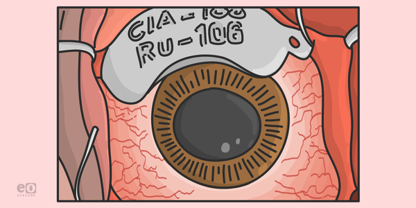 Understanding the Risk Factors for Uveal Melanoma