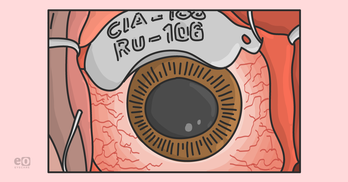 Understanding the Risk Factors for Uveal Melanoma