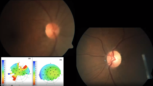 Anterior Uveitis