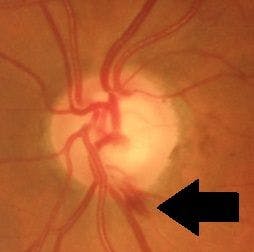 glaucoma drance heme