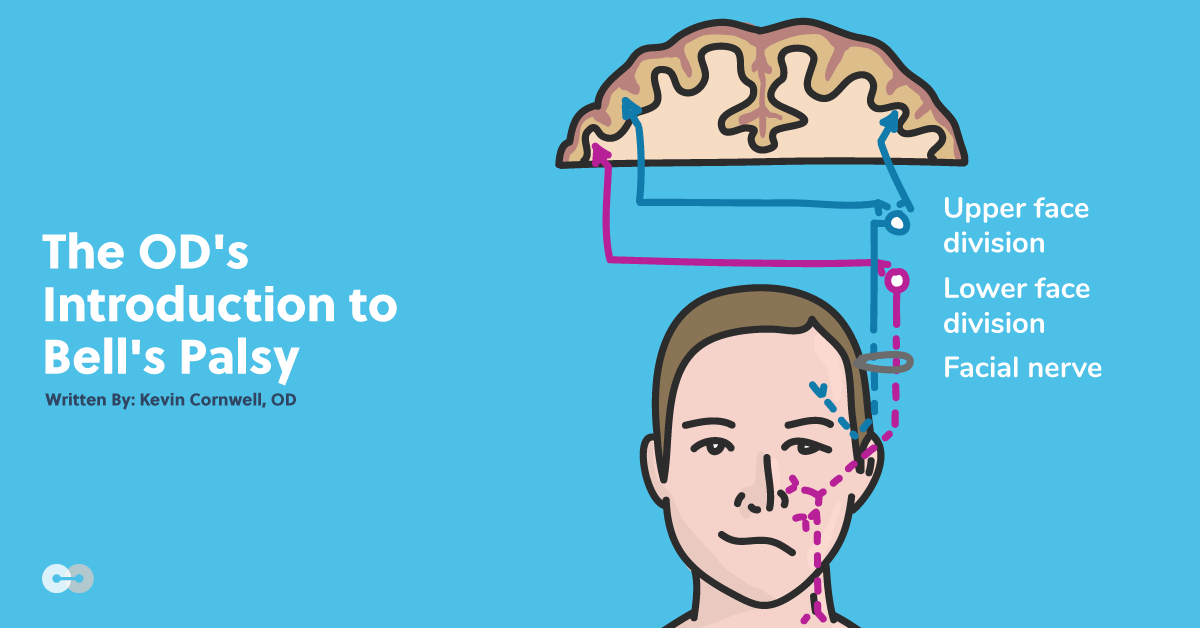 The OD's Introduction to Bell's Palsy