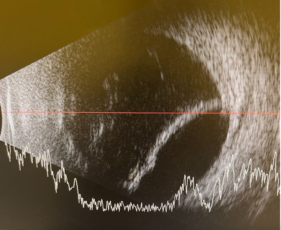 Large Choroidal Effusion