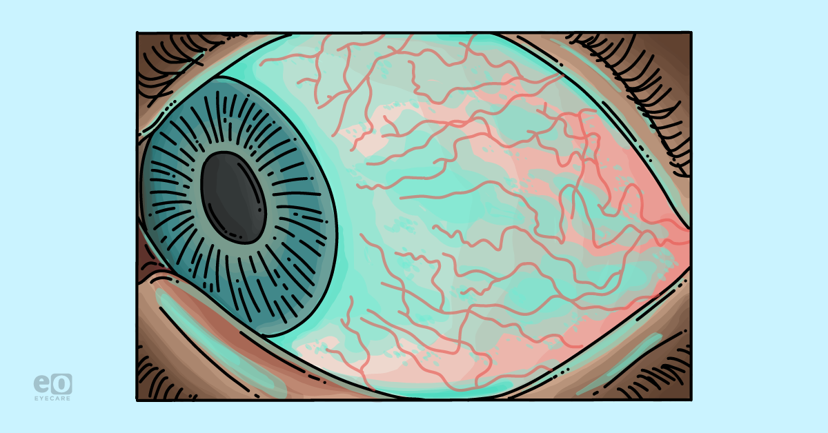 Glaucoma's Impact on the Ocular Surface