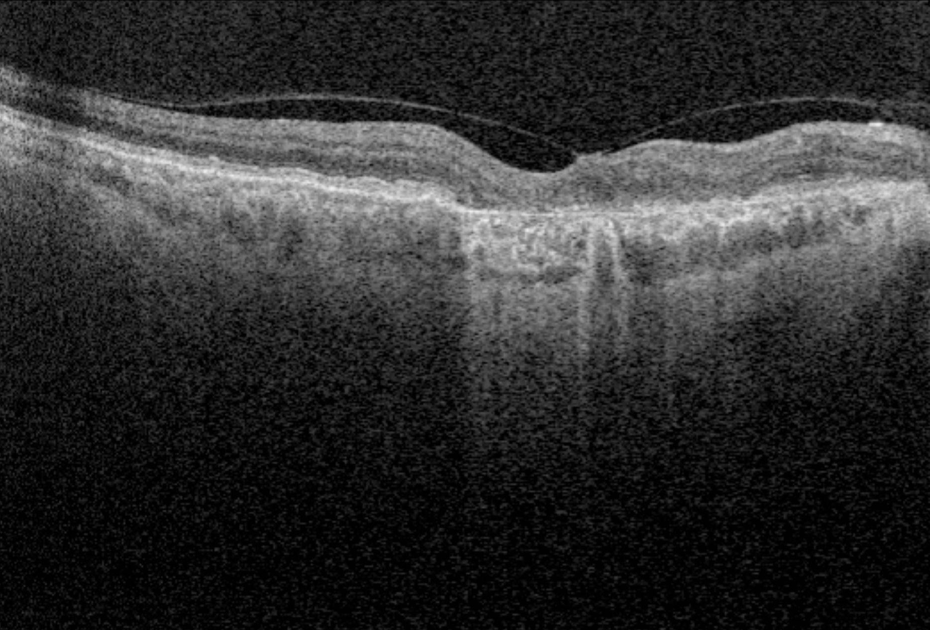 Optical coherence tomography (OCT)