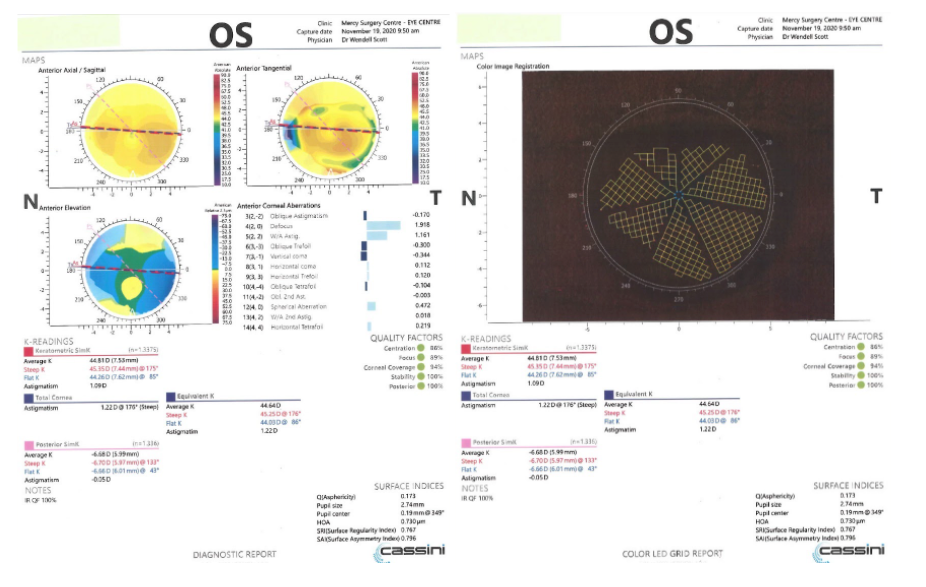 scott case 3 figure 5 jjv astigmatism