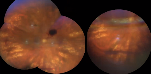 Pre Retinal Hemorrhage