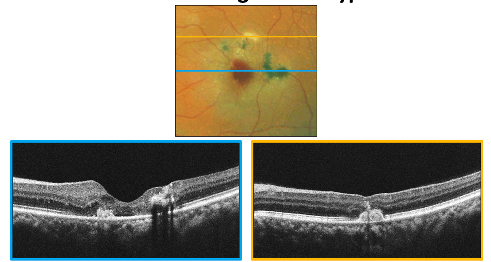 Macular Telangiectasia left eye