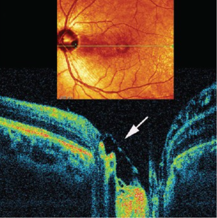 Optic Nerve Pit