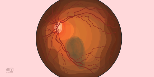 Suspicious Choroidal Lesions: Identifying Melanoma