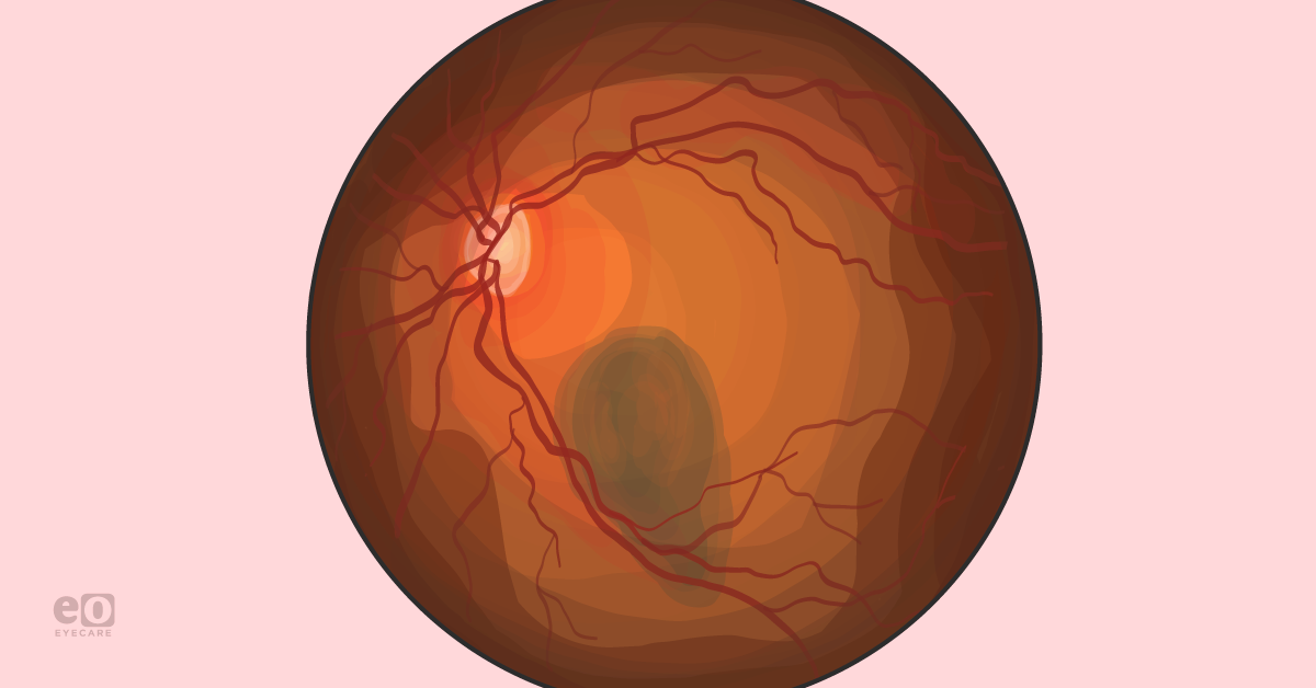 Suspicious Choroidal Lesions: Identifying Melanoma