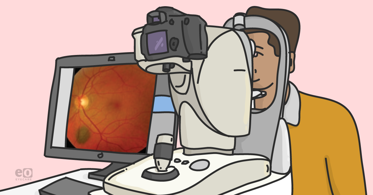 Differential Diagnosis for a Pigmented Fundus Lesion with Downloadable Cheat Sheet