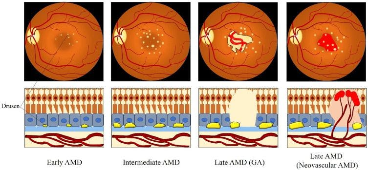 Pathology of AMD