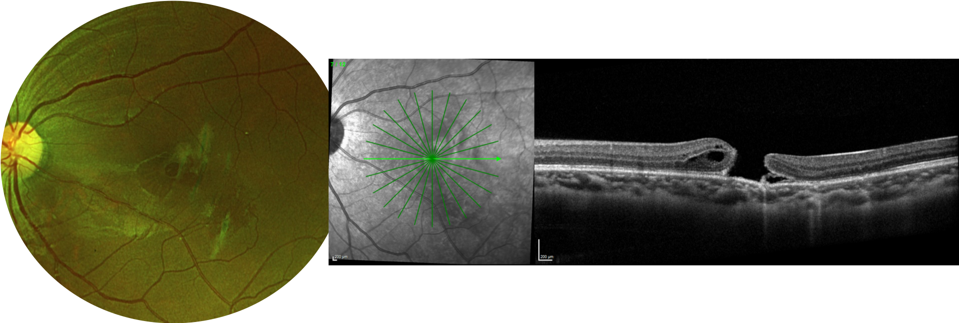 FTMH from Head Trauma