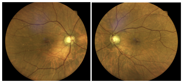 Dilated Fundus Exam