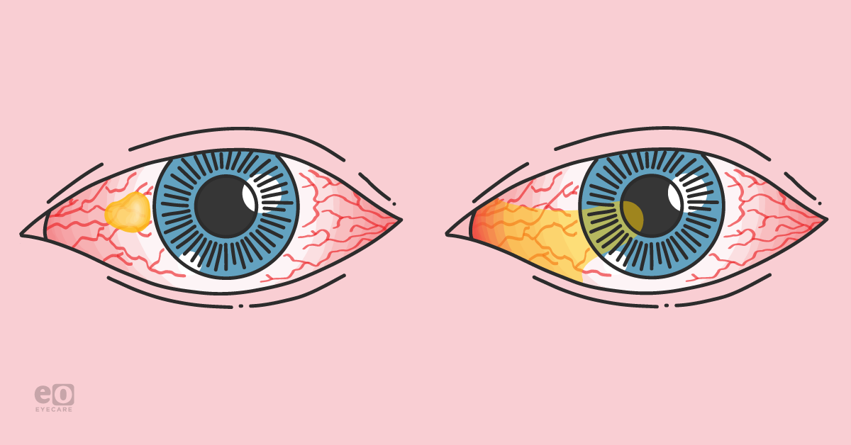 Pterygium vs Pinguecula: What to Know and How to Treat