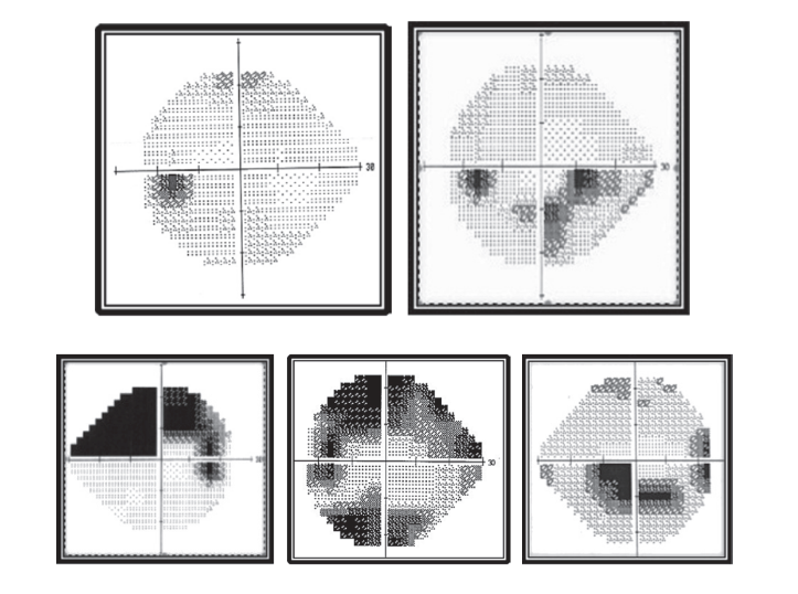 Visual Fields and Glaucoma Progression