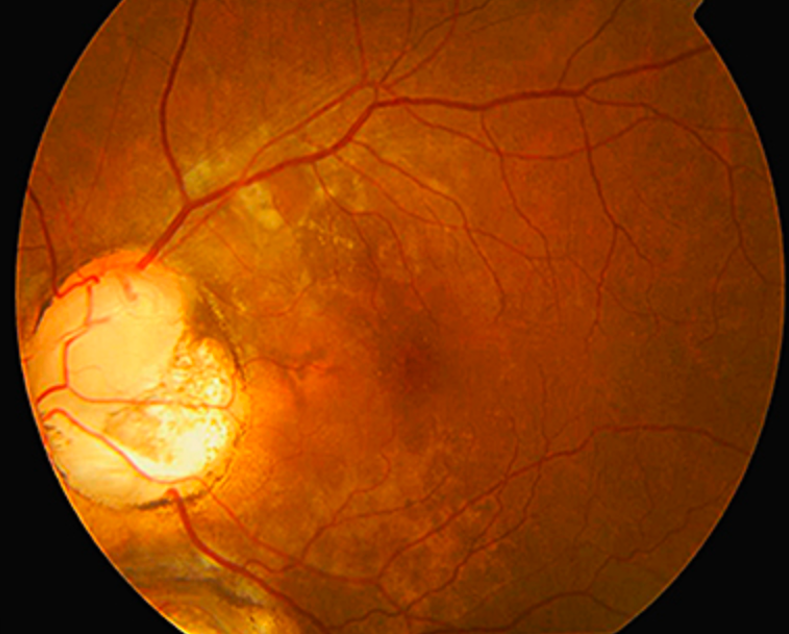 Optic Disc Coloboma