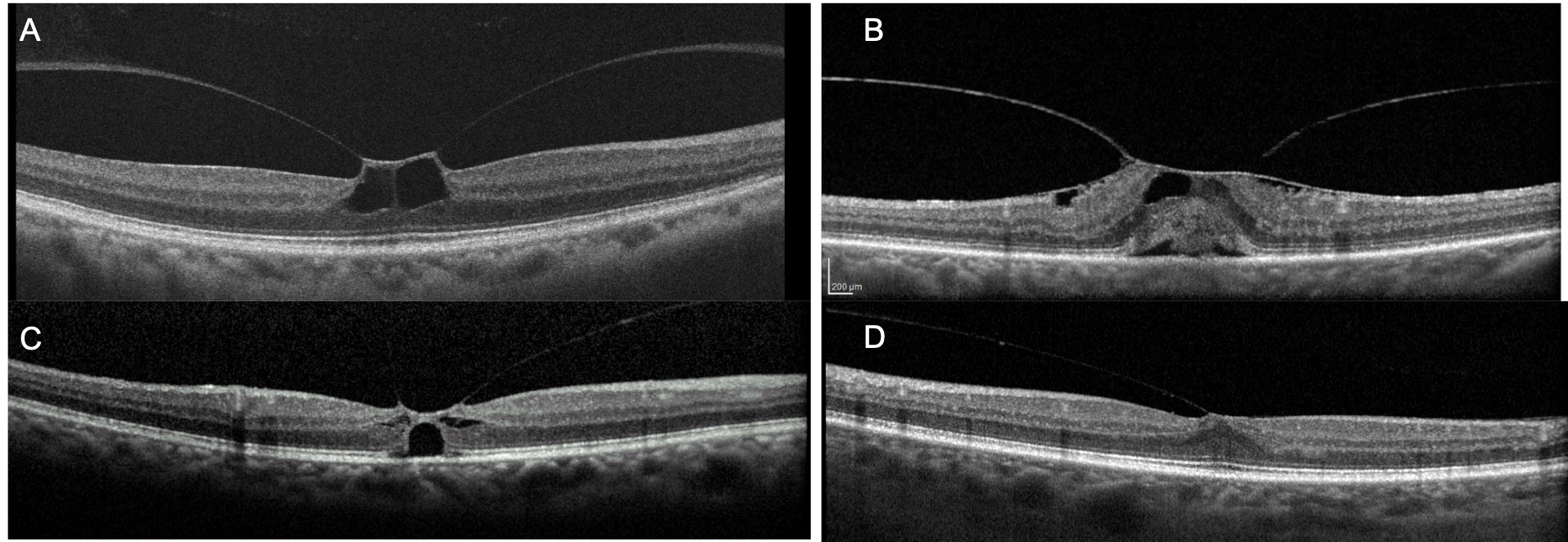 Symptomatic Focal VMT