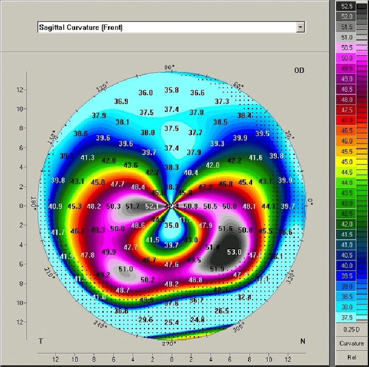 Anterior Sagital Curvature Map Crab Claw