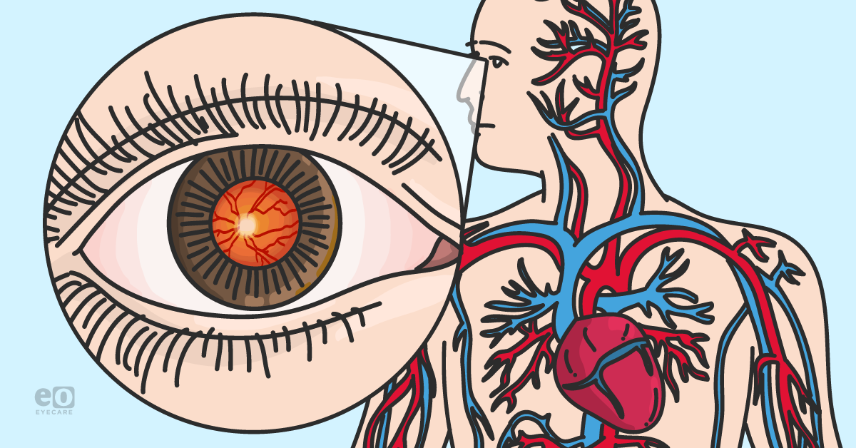 Encountering Systemic Disease in the Optometry Exam Lane