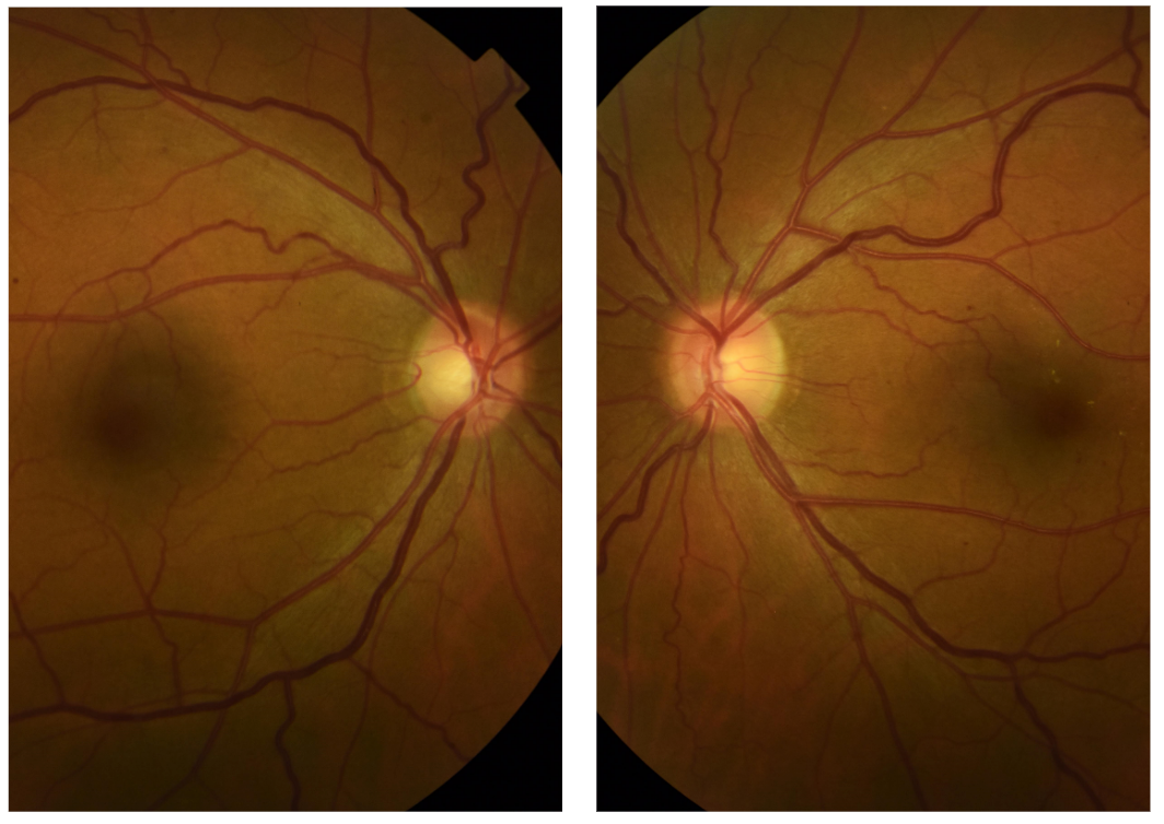 Optic Disc Glaucoma Suspect.png