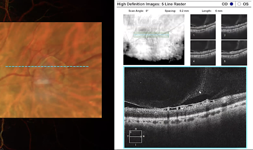 Subtle Vitreous Hemorrhage