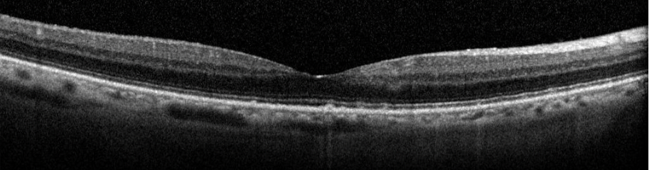 Optical coherence tomography (OCT) imaging of the patient's right eye from 12 years ago that shows a relatively health retina.