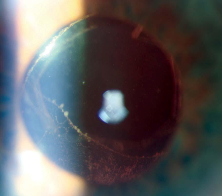 Primary vitreoretinal lymphoma slit lamp