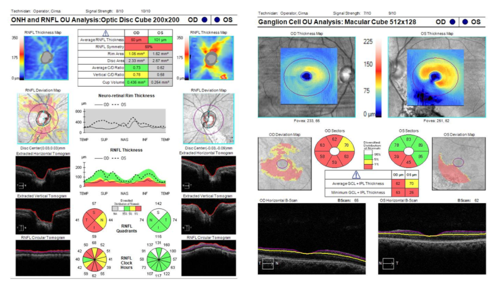 OCT RNFL Macula Thinning