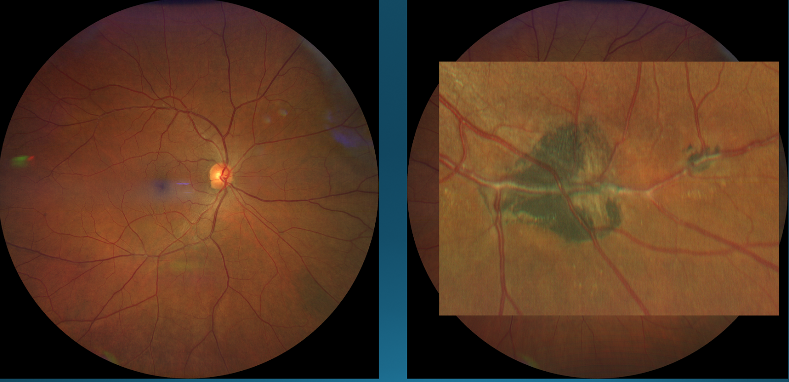 Figure 6: Right Eye (Left); Left Eye (Right)