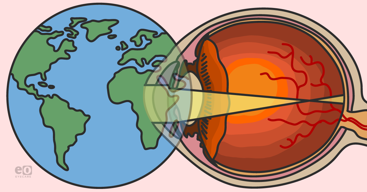 Myopia Awareness and the Evolving Myopigenic Landscape