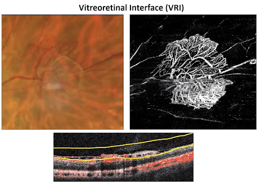 Vitreoretinal Interface Scan