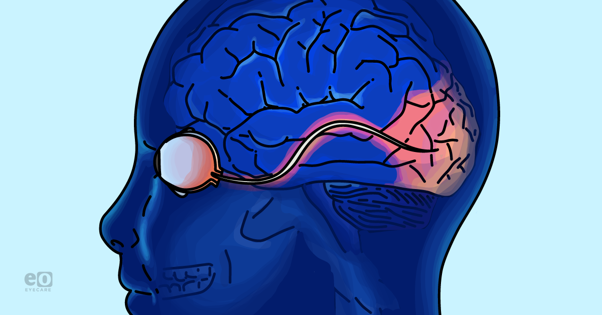 Understanding Cortical Blindness: Essential Guide for Optometrists