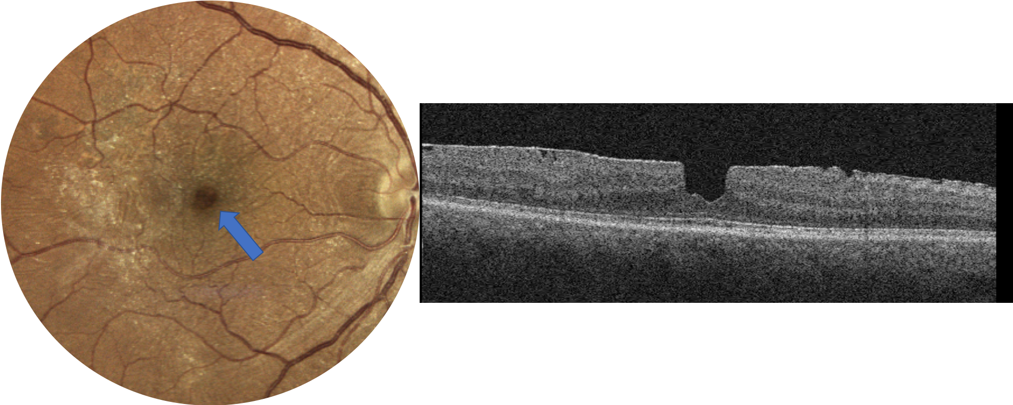 Pseudohole with ERM