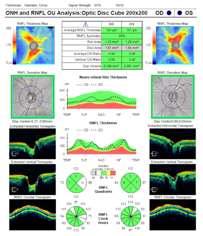 ONH-RNFL  OPtic Disc Cube.png