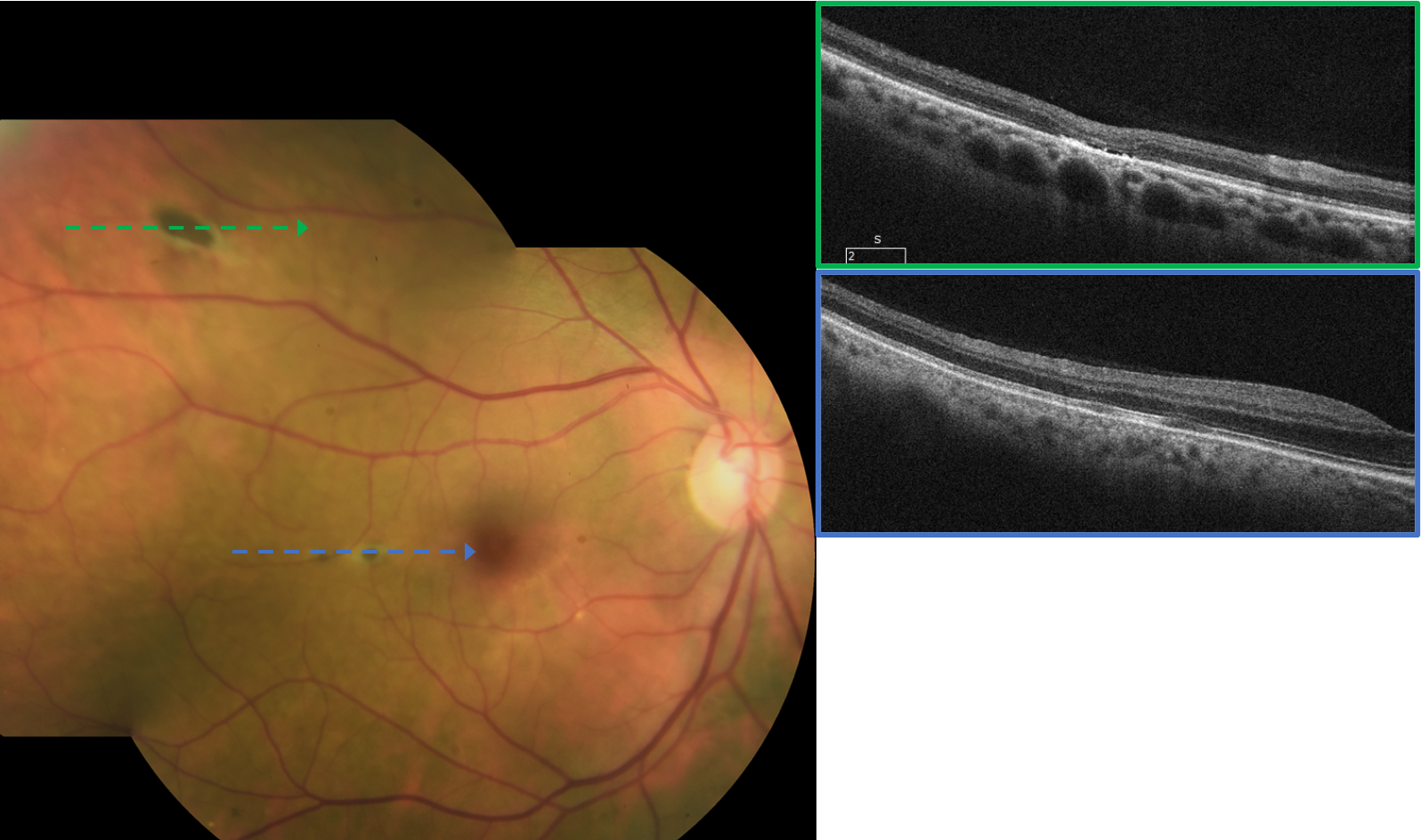 OCT imaging of RPEH-FAP 1