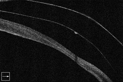 Corneal Thinning