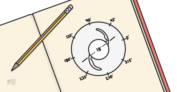 Astigmatism Management in Cataract Surgery