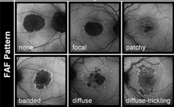 Geographic Atrophy FAF Patterns