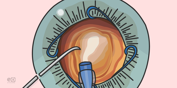 Case Report: Dense Cataract with Malyugin Ring and miLOOP