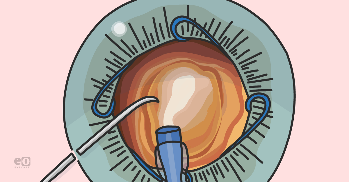 Case Report: Dense Cataract with Malyugin Ring and miLOOP